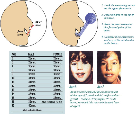 Eric Davis Dental - Mewing: What is Mewing? And Does it Work?