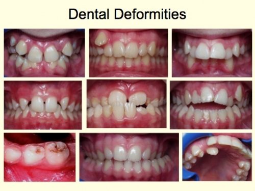 pacifier teeth in adults