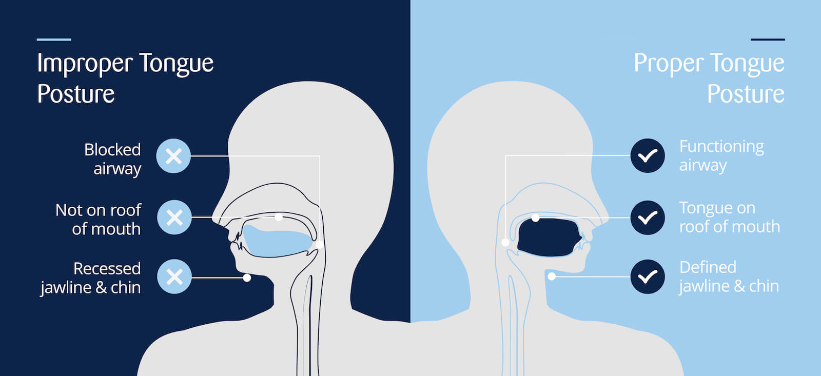 A graphic details the difference between proper tongue posture and poor tongue posture.