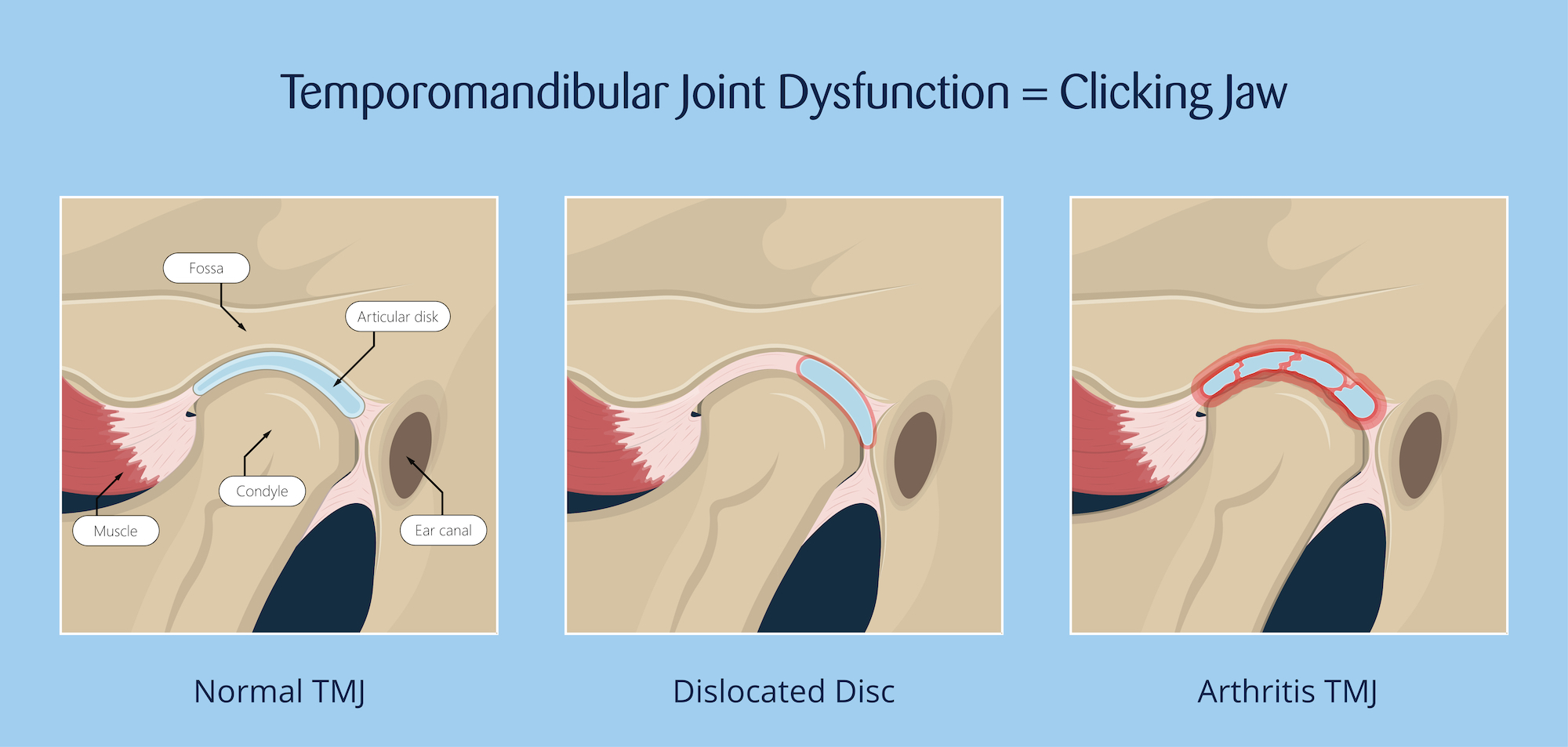 Eric Davis Dental - Clicking Jaw: Jaw Can Be a of TMJ Dysfunction