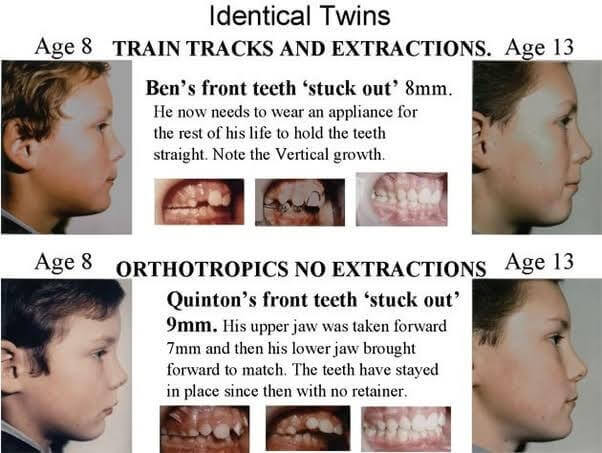 Eric Davis Dental - Overbite: Understanding the Overbite and How to Correct  it