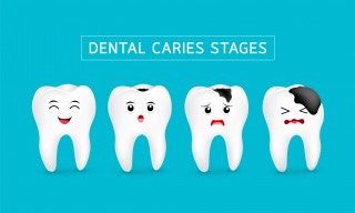 Tooth Decay: What Causes Tooth Decay