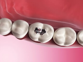 Amalgam Fillings and the Side Effects of Amalgam Removal