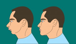 Overbite: Understanding the Overbite and How to Correct it