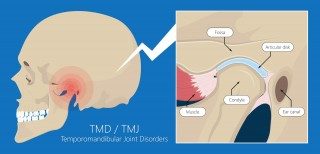 TMJ Dysfunction: Causes, Symptoms and TMJ Treatment