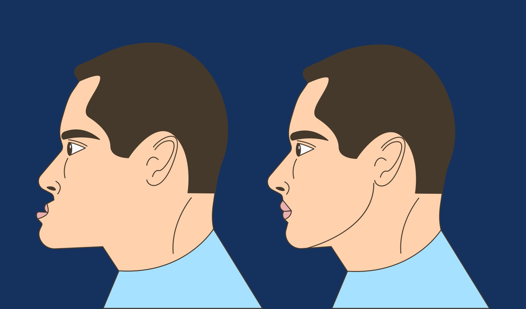 Underbite: What Causes it and How to Fix it