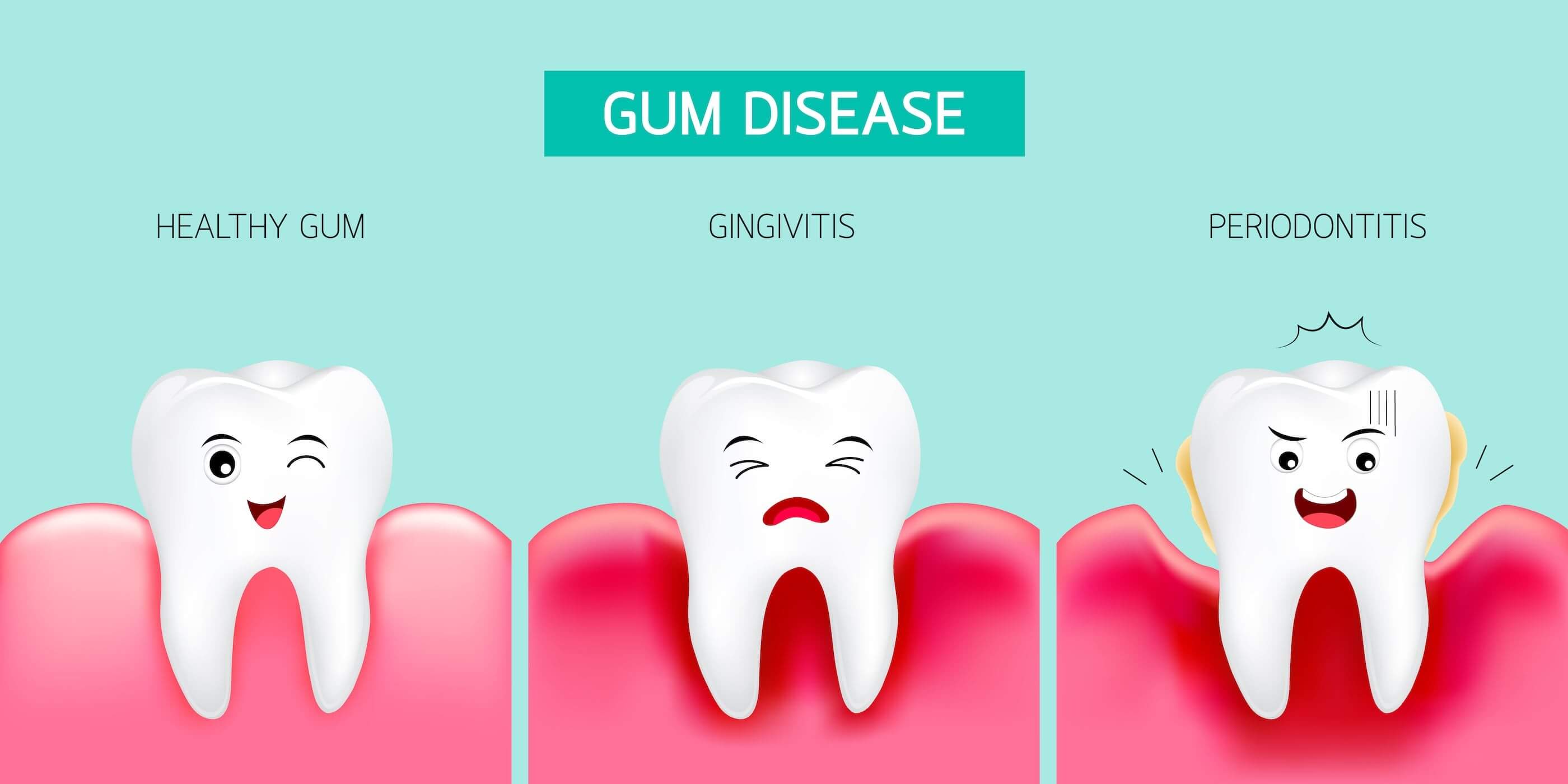 Gum Disease: What to do After Treatment