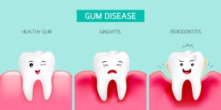 Gum Disease: What to do After Treatment